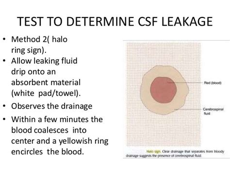 halo sign csf|Ear Drainage After Trauma